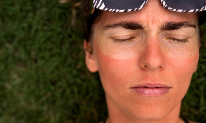 Exposição solar das férias pode deixar marcas na pele