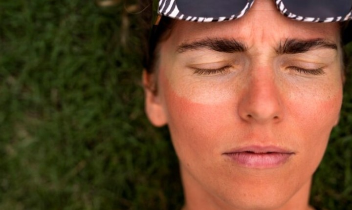 Queimaduras solares de pele no verão: o que fazer?