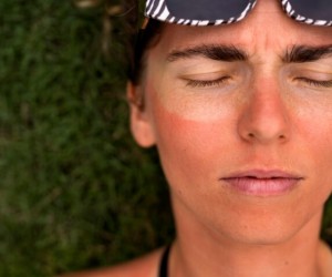 Queimaduras solares de pele no verão: o que fazer?