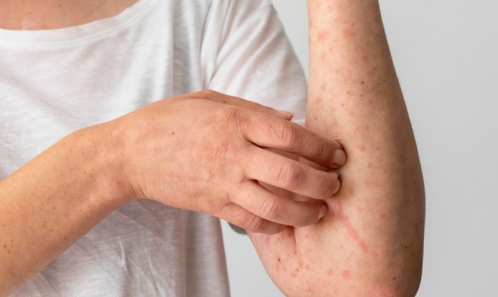 Pele reage ao calor e revela condição pouco conhecida