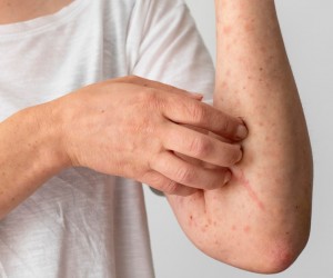 Pele reage ao calor e revela condição pouco conhecida