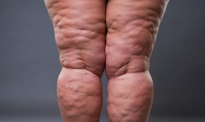 Lipedema no verão: por que as pernas sofrem mais?